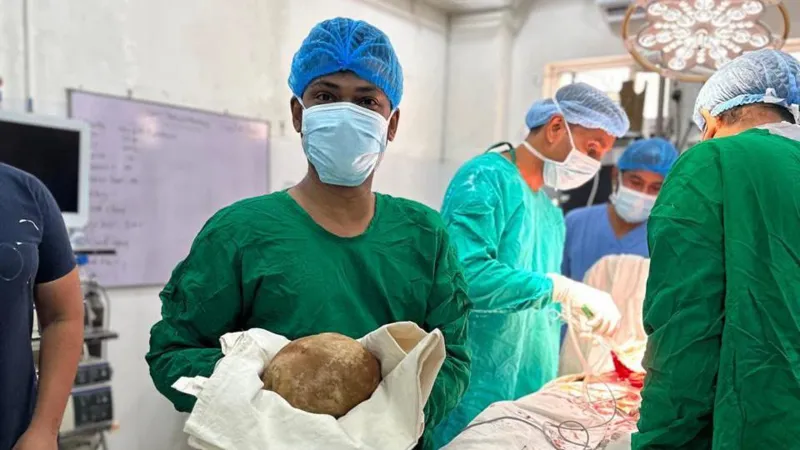 श्रीलंकामा पुरुषको मूत्रथैलीबाट ३.१ किलोको ढुंगा निकालियो
